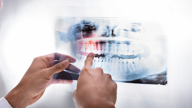 Ukiah Oral Surgery Dental Implants | Oral Facial Trauma, Frenectomy and Apicoectomy